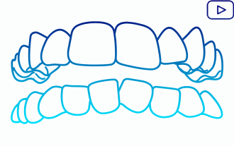 Dientes apiñados