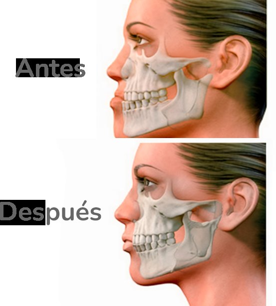 Ilustración referencial del reposicionamiento maxilar; no corresponde a un caso real
