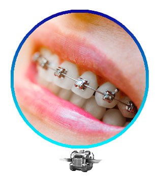 Brackets autoligables