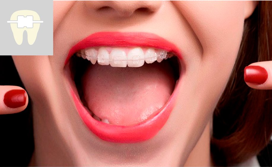 Brackets estéticos