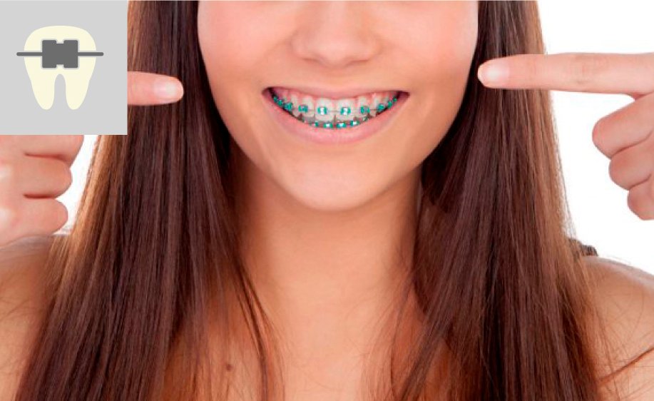 Brackets y frenillos
